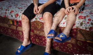 血小板低有什么危险